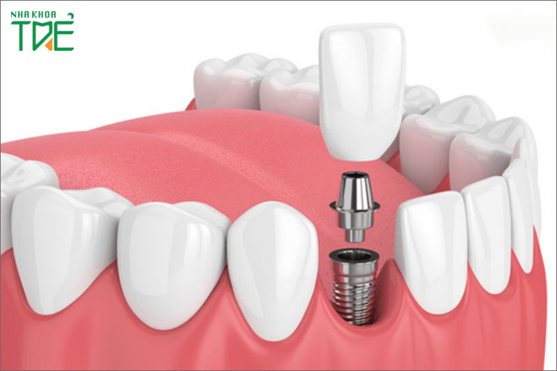 Trồng răng Implant phục hình tối ưu nhất