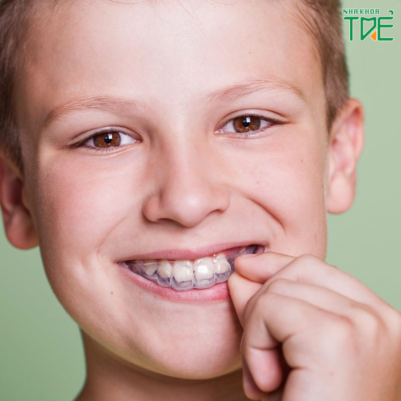 Niềng răng máng nhựa cho trẻ có tốt không? Giá bao nhiêu?