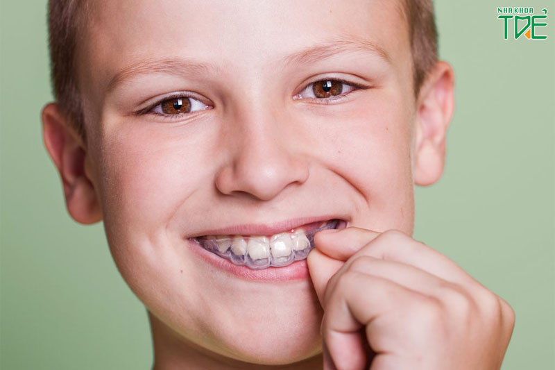 Niềng răng máng nhựa cho trẻ có tốt không? Giá bao nhiêu?