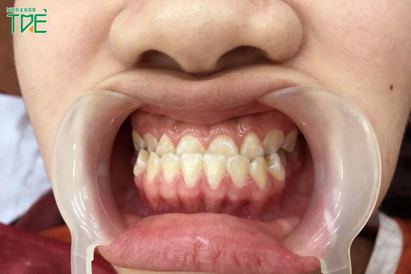 Răng móm: răng hàm dưới phủ ngoài răng hàm trên gây mất thẩm mỹ