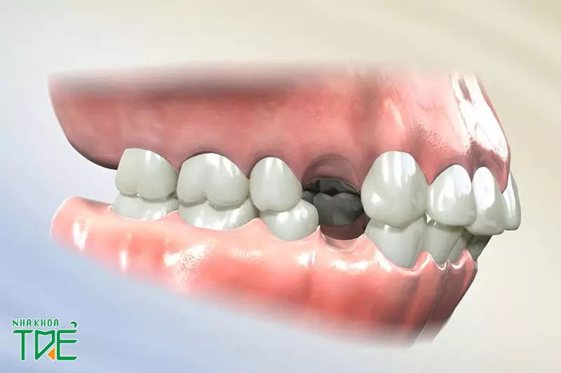 Chỉ định nhổ răng để niềng thường là răng số 4
