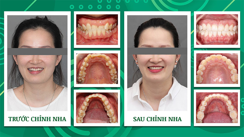 Hình ảnh niềng răng trước và sau khắc phục răng móm