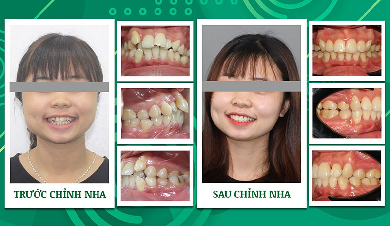 Hình ảnh trước và sau niềng răng hô vẩu