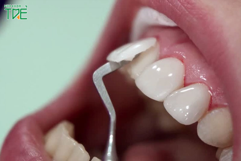 Quy trình tháo răng sứ như thế nào? Có đau không?