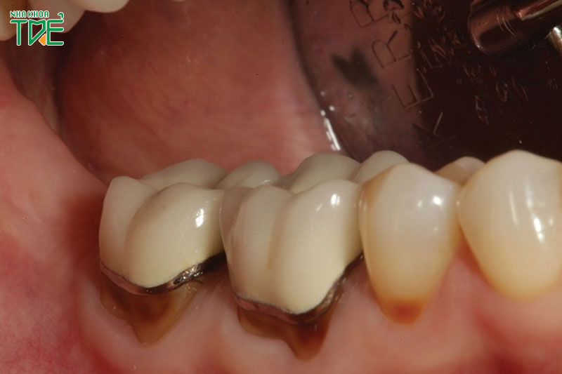 Răng sứ bị hỏng, bị đen viền nướu có thể tháo răng sứ để làm lại