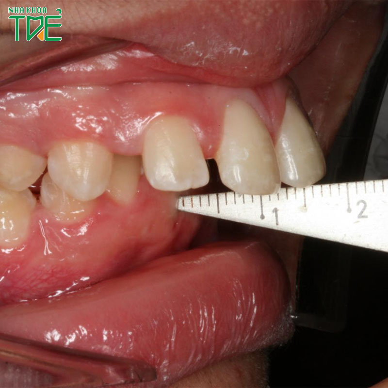 Răng bị vẩu nguyên nhân do đâu? Giải pháp điều trị hiệu quả