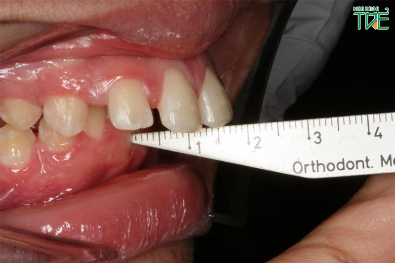 Răng bị vẩu thì răng hàm trên sẽ bị chìa ra quá mức so với hàm dưới