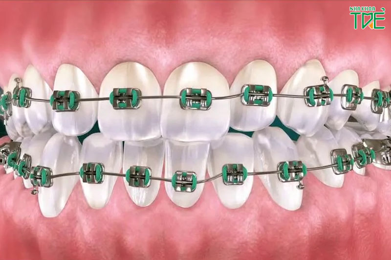 Niềng răng giúp dàn đều răng hô vẩu một cách hiệu quả