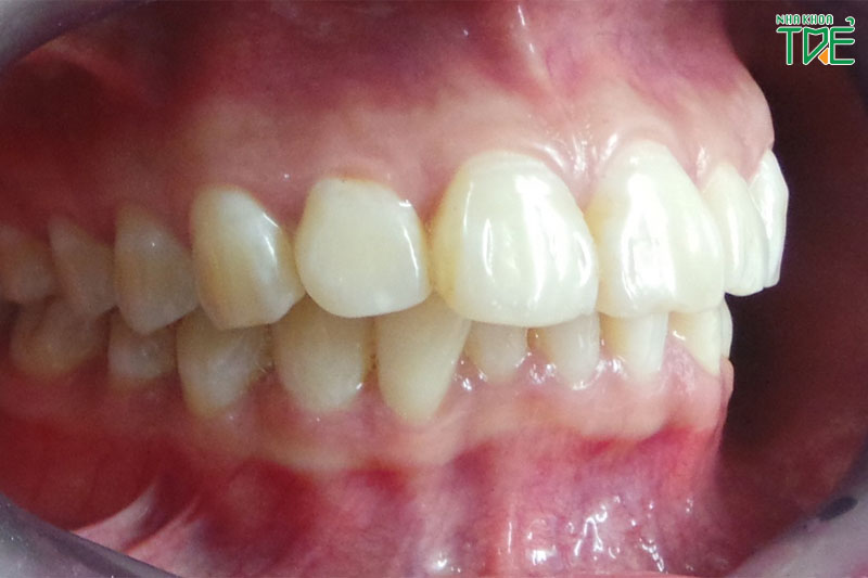  Răng hô nhẹ - nhóm răng cửa hàm trên chếch ra trước nhiều hơn bình thường