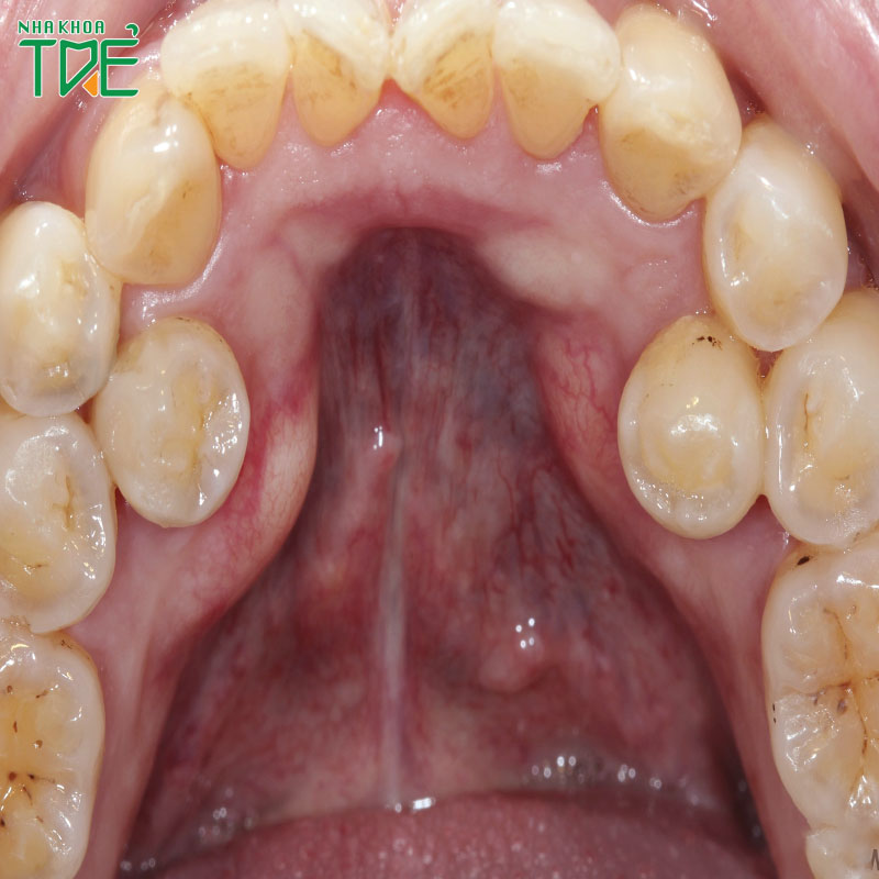 Răng mọc trong vòm miệng phải xử lý như thế nào?