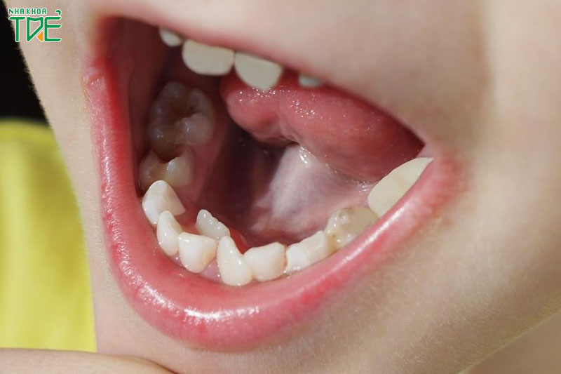 Răng thừa mọc chen lấn vào răng cửa