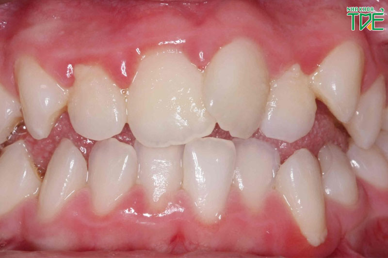 Răng nanh thường mọc khểnh, ít trường hợp răng nanh mọc lệch vào trong