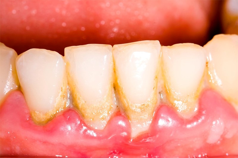 Không đánh răng vào buổi tối gây ra hàng ngàn vi khuẩn