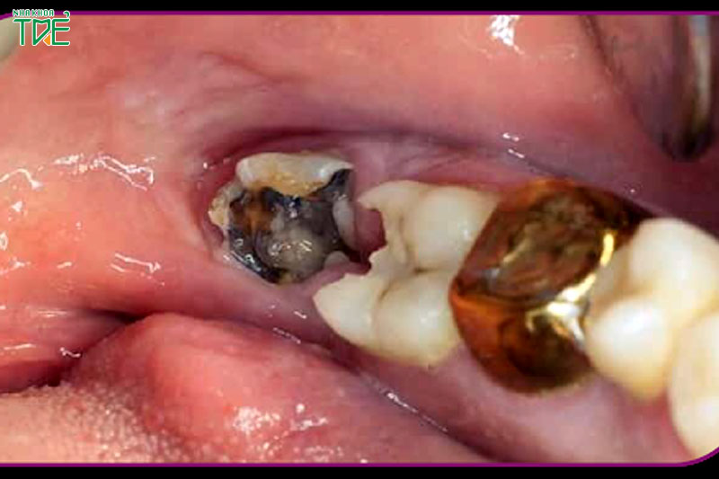 Răng số 8 bị sâu hỏng sẽ lây lan sang các răng kế cận
