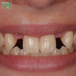 Thiếu răng số 2 gây ảnh hưởng gì? Cách khắc phục như thế nào?