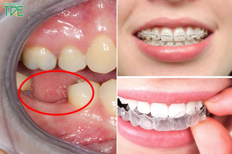 Tiêu xương hàm có niềng răng được không? Cần điều trị như thế nào?