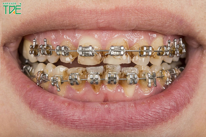 Niềng răng bị tiêu xương hàm gây ra nhiều vấn đề răng miệng