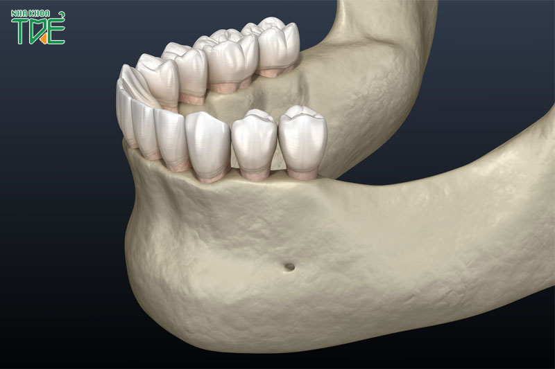 Tiêu xương hàm có trồng răng được không? Giải pháp nào phù hợp?