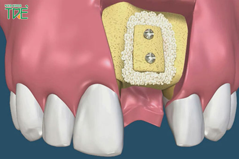Cần ghép xương hàm trước khi trồng răng