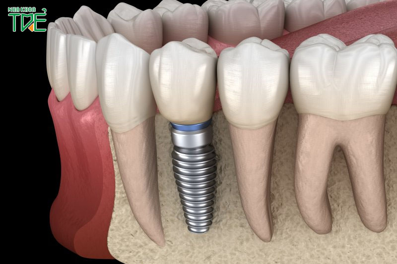 Trồng răng Implant ngăn ngừa biến chứng tiêu xương hàm