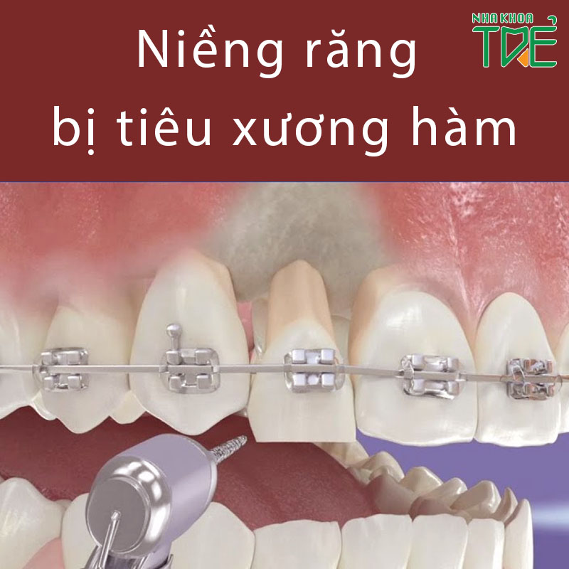 Tiêu xương khi niềng răng có nguy hiểm không? Cách khắc phục như thế nào?