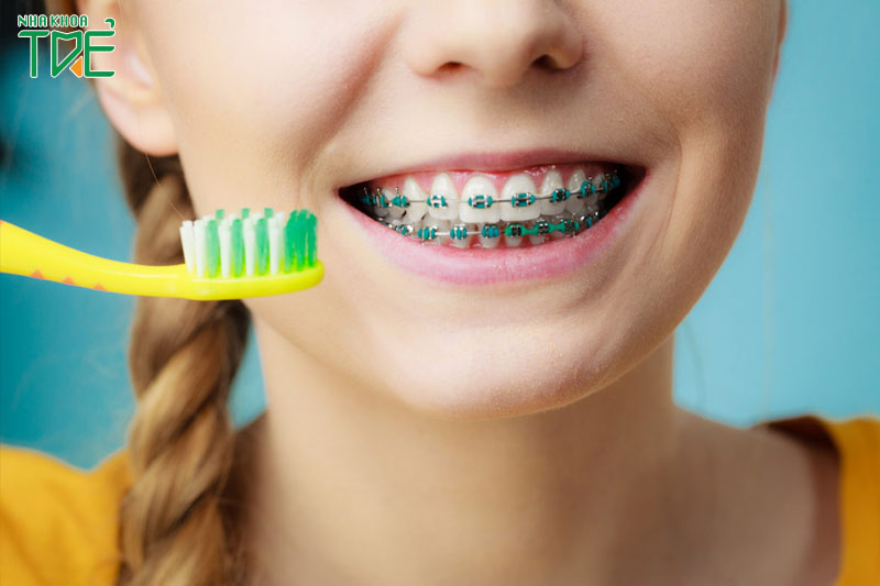 Vệ sinh răng niềng đúng cách để quá trình chỉnh nha diễn ra thuận lợi