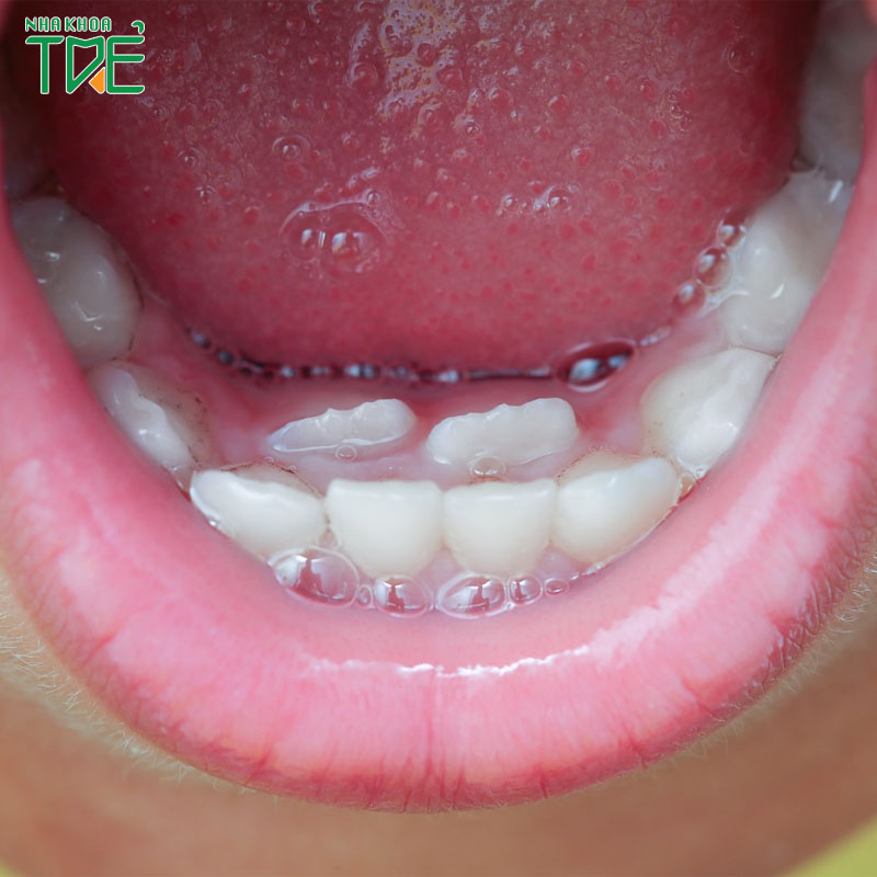 Mọc răng đôi là hiện tượng gì? Nguyên nhân và cách xử lý như thế nào?