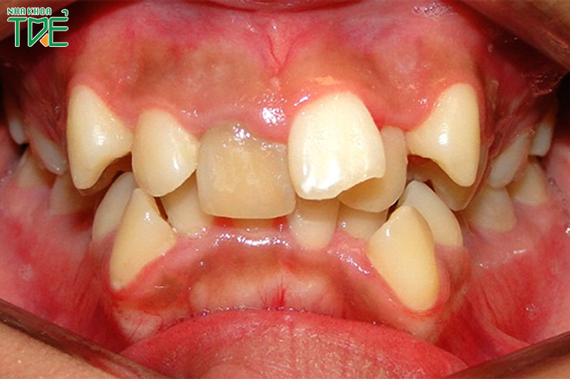 Hàm răng đôi gây sai lệch khớp cắn nghiêm trọng