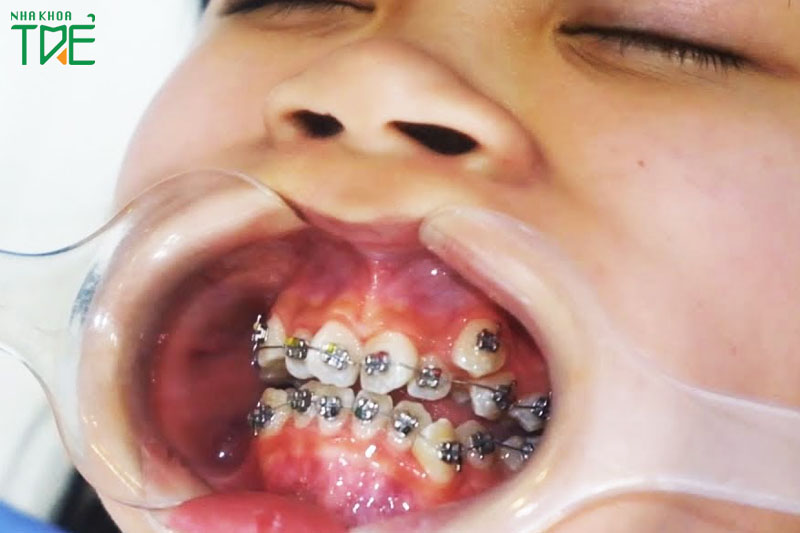 Niềng răng cho trẻ - giải pháp tối ưu để khắc phục răng lệch lạc