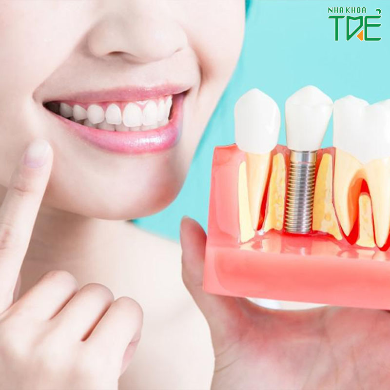 Trồng răng Implant cho răng số 6 – Giải pháp phục hình tối ưu nhất