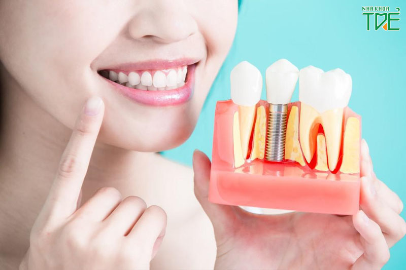 Trồng răng Implant cho răng số 6 – Giải pháp phục hình tối ưu nhất
