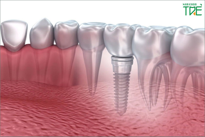Răng Implant có cấu trúc như răng thật, có độ bền chắc tốt