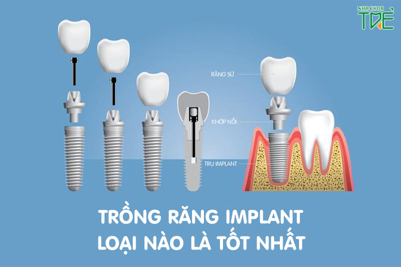 Trồng răng Implant loại nào tốt? Chi phí là bao nhiêu?
