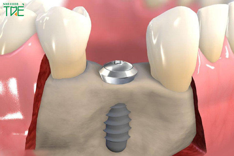 Trồng răng Implant sẽ cấy ghép trực tiếp trụ răng vào xương hàm