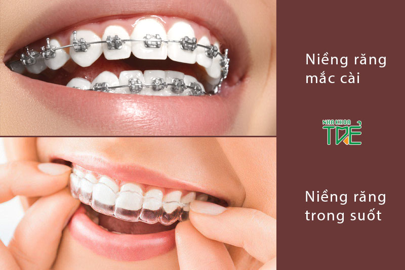 Hai phương pháp niềng răng phổ biến tại nha khoa