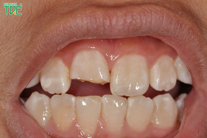Tự nhiên răng bị mẻ là do đâu? Cách điều trị như thế nào?