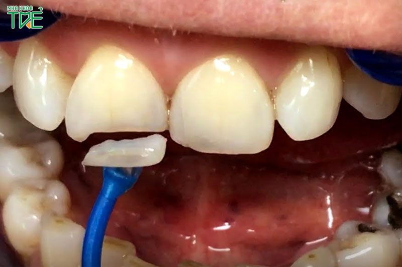 Mảng răng vỡ có thể được sử dụng để trám lại vào răng