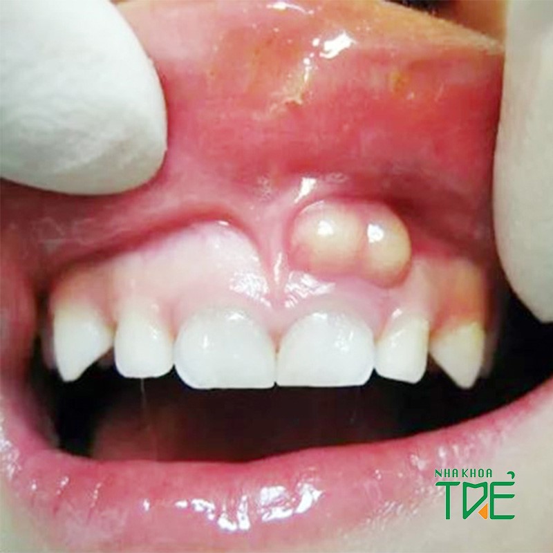 U nang răng là gì và cách ngăn ngừa như thế nào?
