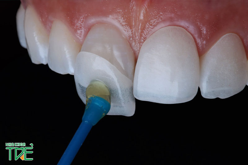 Bọc răng sứ sai kỹ thuật là nguyên nhân chính gây đau nhức hàm