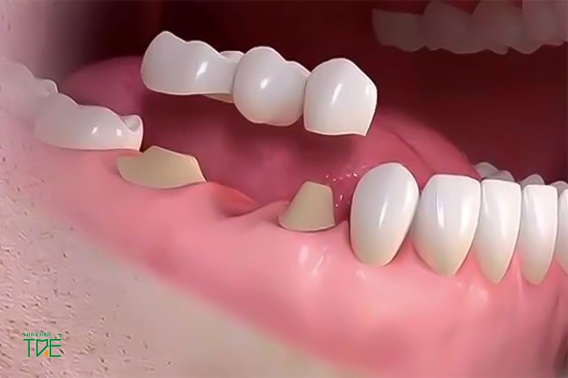 Bọc răng sứ dính liền có ưu điểm và nhược điểm gì?