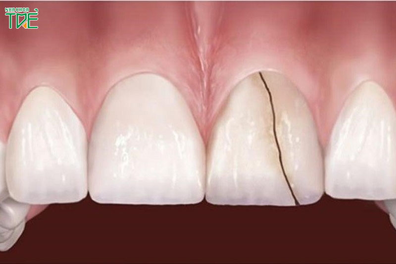 Bọc răng sứ lần thứ 2 khi răng sứ trước đó bị vỡ, nứt có thể gây các bệnh lý răng miệng