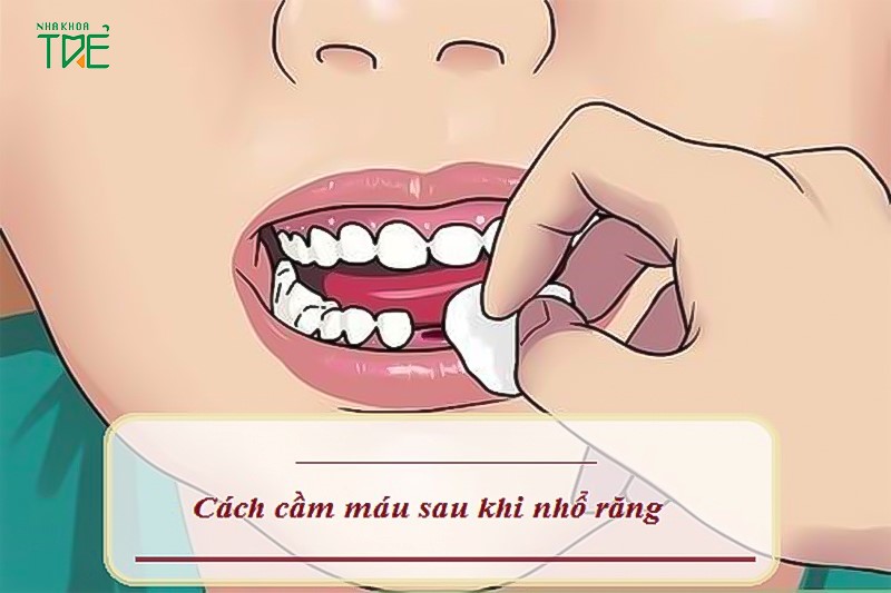 Cầm máu sau nhổ răng bằng cách nào?