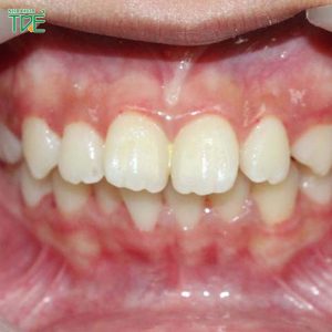 [Tiết lộ] Giải pháp nào chỉnh răng hô không cần niềng răng?