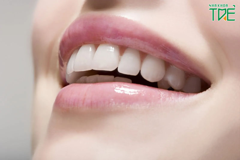 Bọc răng sứ khắc phục răng hô vẩu