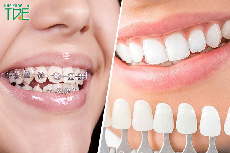 Bọc răng sứ: Phương pháp chỉnh răng mọc lệch không cần niềng