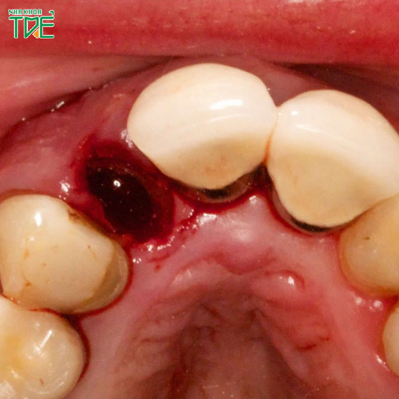 Cục máu đông sau nhổ răng hình thành như thế nào? Có tác dụng gì?