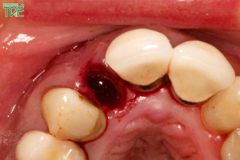 Cục máu đông sau nhổ răng hình thành như thế nào? Có tác dụng gì?