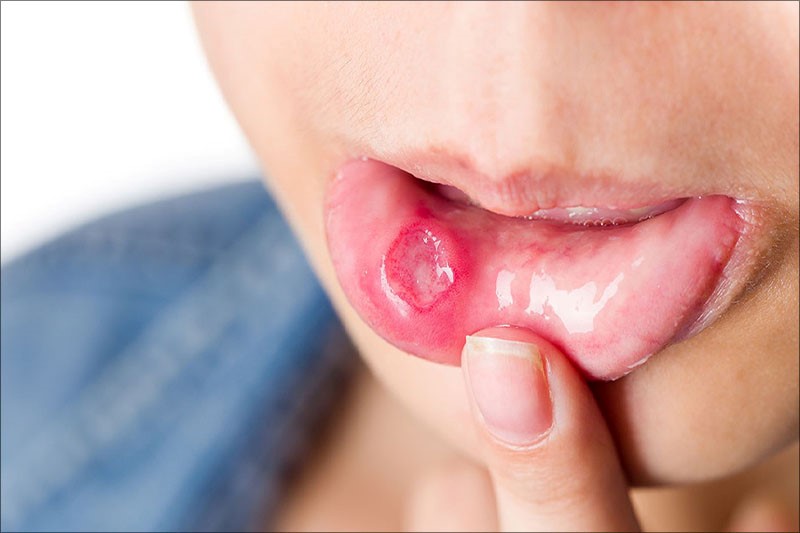 Loét, chảy máu niêm mạc miệng là một dấu hiệu khi mới niềng răng