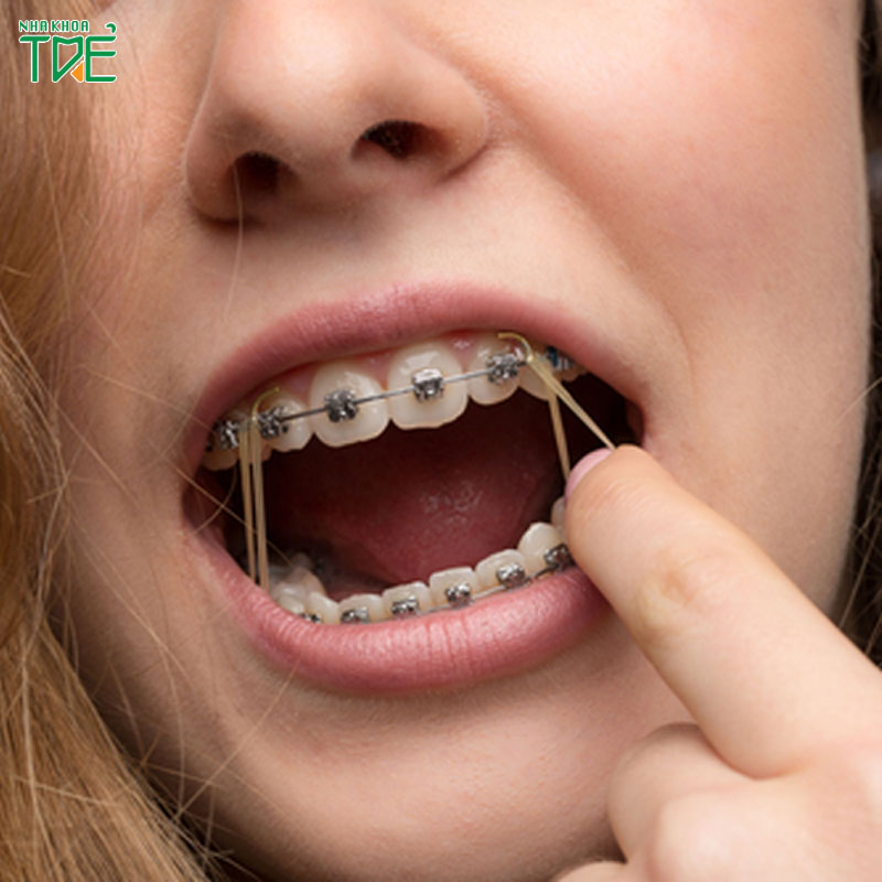 Dây thun niềng răng bị vàng cần xử lý như thế nào?