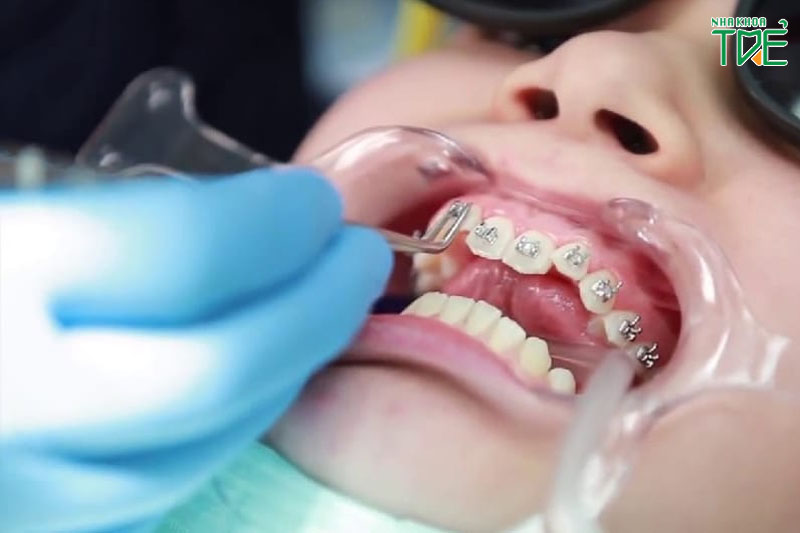 Niềng răng nắn chỉnh răng và khớp cắn hiệu quả